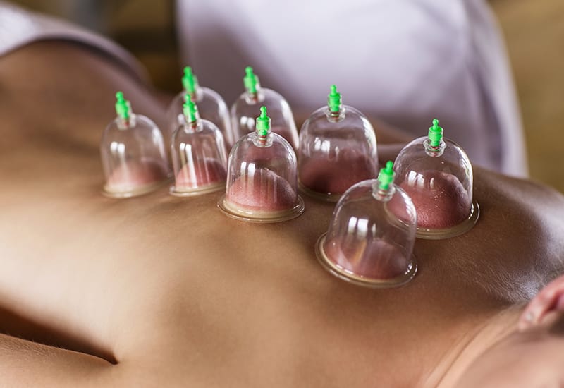 Cupping Therapy